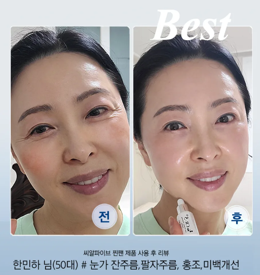 점 뺀 후 색소침착 예방